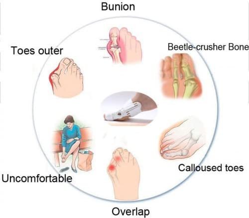 مصحح القدم الأبيض والجبيرة - الصورة 6